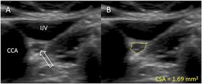 Vagus Nerve Cross-Sectional Area in Patients With Parkinson's Disease—An Ultrasound Case-Control Study